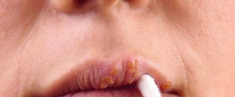 How to quickly cure herpes: folk remedies