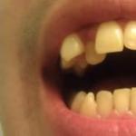 Вирівнювання зубів у дорослих та дітей: ціни та відгуки Вирівнювання прикусу без брекетів у дорослих