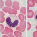Segmenterade neutrofiler i ett blodprov - orsaker och konsekvenser av avvikelser från normen hos barn eller vuxna Segmenterade neutrofiler 68