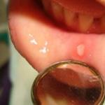 Stomatitis kod djece: kako liječiti, fotografije faza razvoja Stomatitis 10 mjeseci liječenja