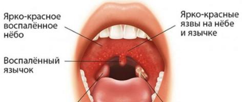 Herpetic sore throat in children - features of treatment