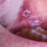 Характеристика злокачественных опухолей полости рта