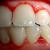 Лечение на гингивит в стоматологията и у дома, рецепти